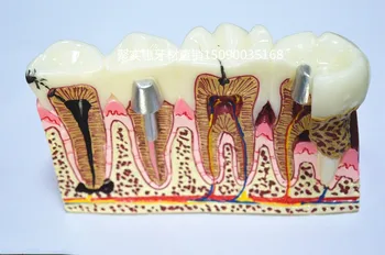 Materiale dentare dinte patologie Disecție model de dinte Cariat Gingivale Disecție transport gratuit
